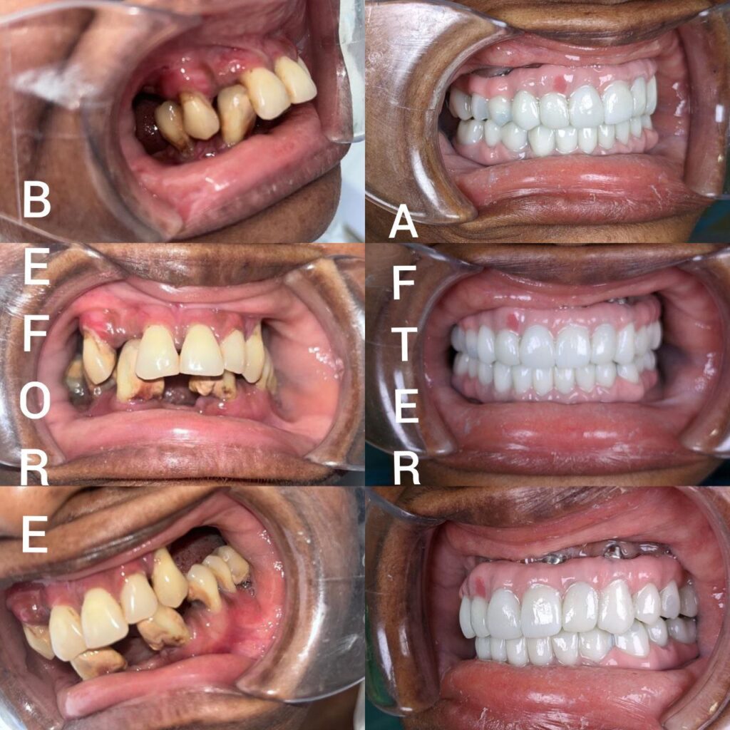 All-On-6-Treatment
